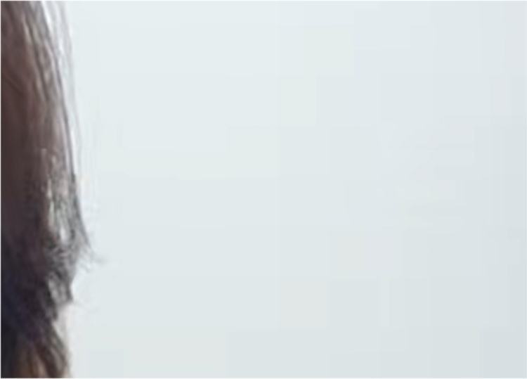 Double Eyelid Revision Surgery Review: You Must Be Careful with Extremely Difficult Eyes image 23