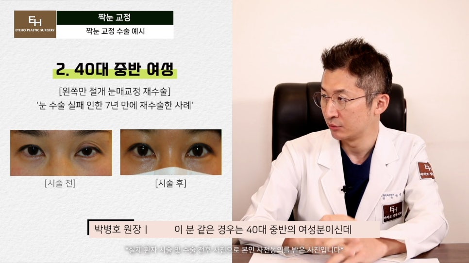 짝눈이 고민인데 양쪽 눈 수술하기 싫어요!! 한쪽 눈만 수술 가능!? 관련 이미지 10