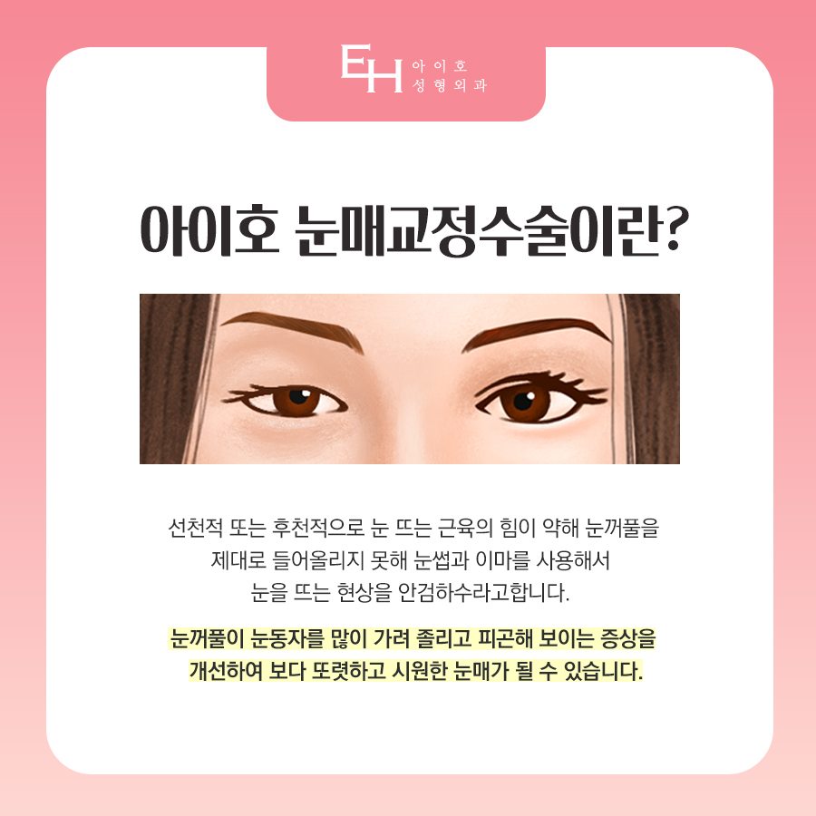 눈매교정수술전후 호감 가는 인상을 위해 맞춤형으로 관련 이미지 4
