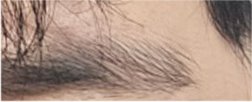 For a Natural Eye Shape Before and After Male Eye Surgery image 20