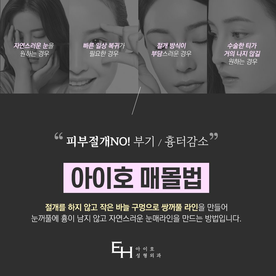 쌍수 매몰법 눈성형잘하는병원 후기 신중히 살핀다면 관련 이미지 4