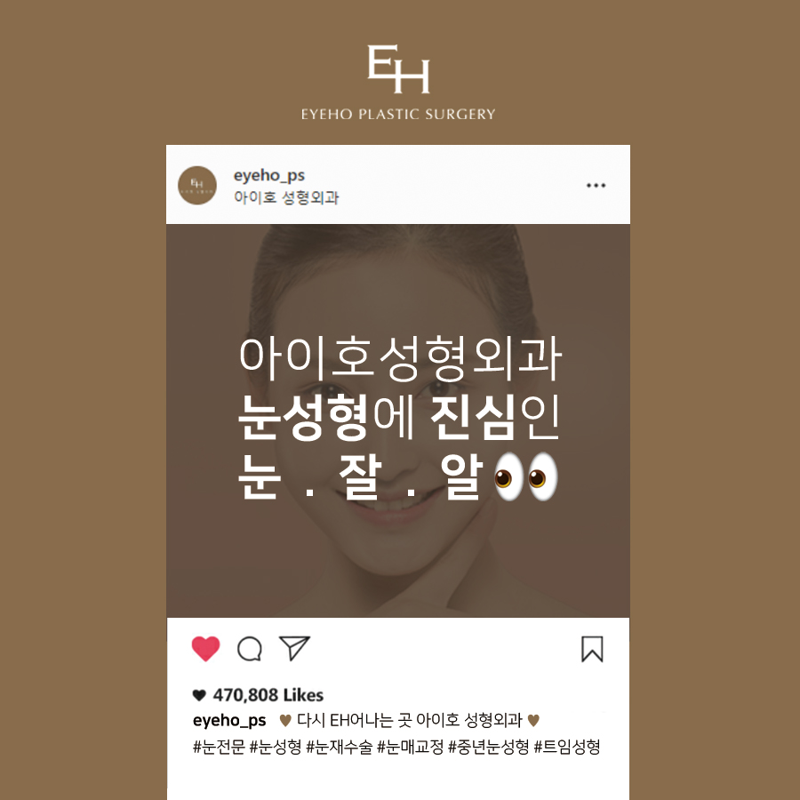 상안검 수술 후기 : 상안검수술비용 그리고 회복기간 관련 이미지 7