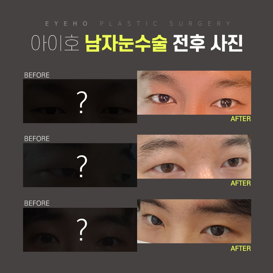 남자눈수술 느끼하지 않는 담백한 라인을 관련 이미지 5