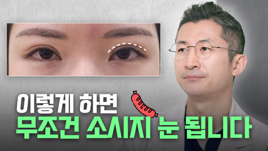 소세지눈 다 같은 게 아니다!? 유형별 재수술 방법에 대해 알려드리겠습니다. 관련 이미지 66