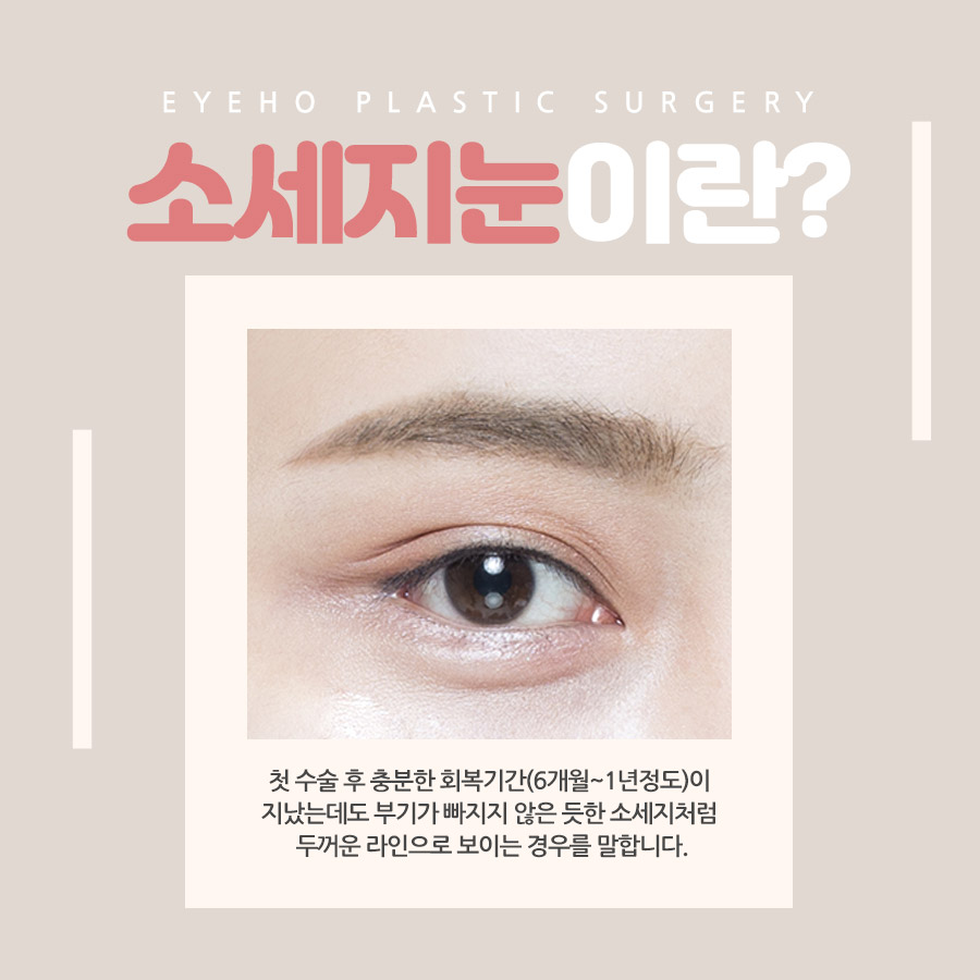 소세지눈 재수술 붓기 고민하지 않으려면 관련 이미지 2