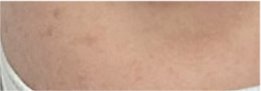 For a Natural Eye Shape Before and After Male Eye Surgery image 24