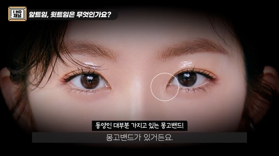 앞트임, 윗트임 하지 말아야할 눈!! 관련 이미지 3