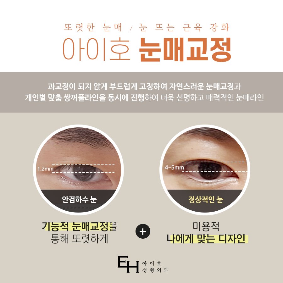 속쌍눈매교정 자연스럽게 원한다면 아이호성형외과 관련 이미지 3