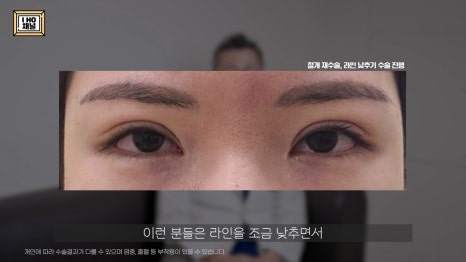 소세지눈 다 같은 게 아니다!? 유형별 재수술 방법에 대해 알려드리겠습니다. 관련 이미지 54