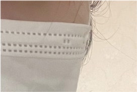 남자 눈매교정 가격 및 남자 눈매교정 전후 차이 비교 분석 관련 이미지 25
