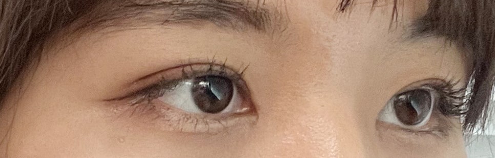 Famous Eye Plastic Surgery Clinic for Incisionless Double Eyelid Surgery, for an Attractive Eye Line image 1