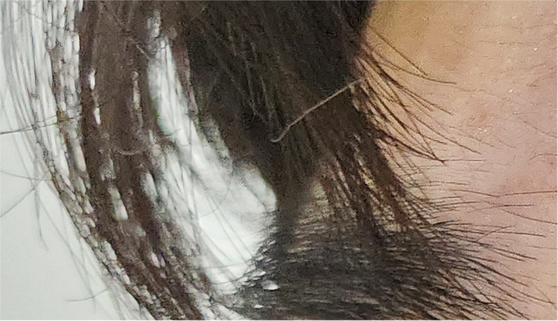 Effectively Achieving a Natural Look with Male Eye Surgery image 24
