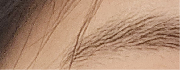 쌍수매몰법 매력적인 나만의 라인으로 관련 이미지 18