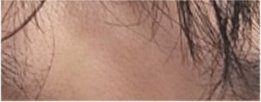 For a Natural Eye Shape Before and After Male Eye Surgery image 19