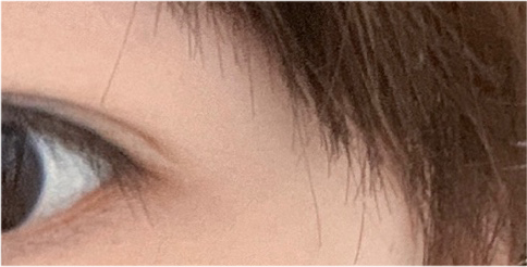 안검하수눈매교정 눈 처짐 고민된다면 관련 이미지 22