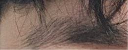 For a Natural Eye Shape Before and After Male Eye Surgery image 18