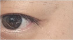 For a Natural Eye Shape Before and After Male Eye Surgery image 23