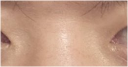 For a Natural Eye Shape Before and After Male Eye Surgery image 22