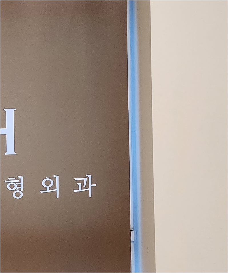 하안검 수술 / 하안검 수술 후기 및 하안검 수술비용 그리고 부작용 관련 이미지 22