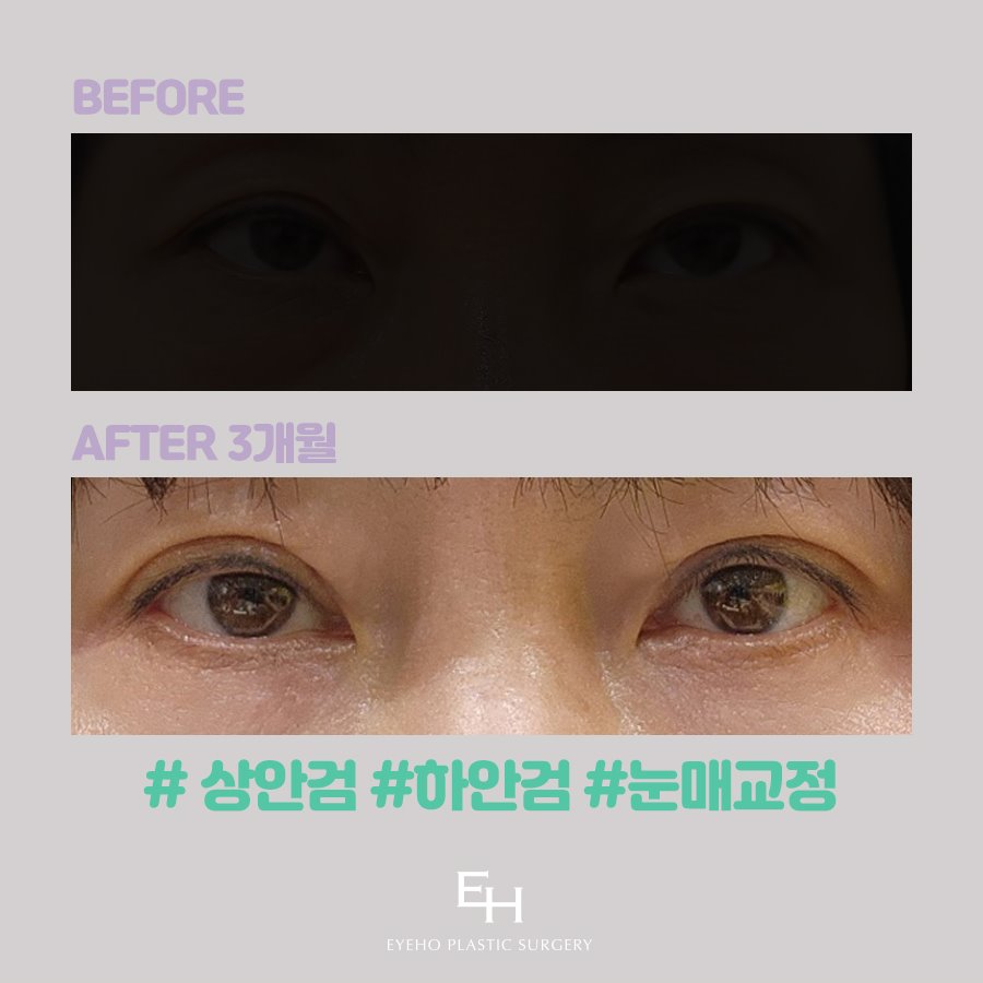 Comparison of the Differences in Reviews of Upper and Lower Eyelid Surgery image 15