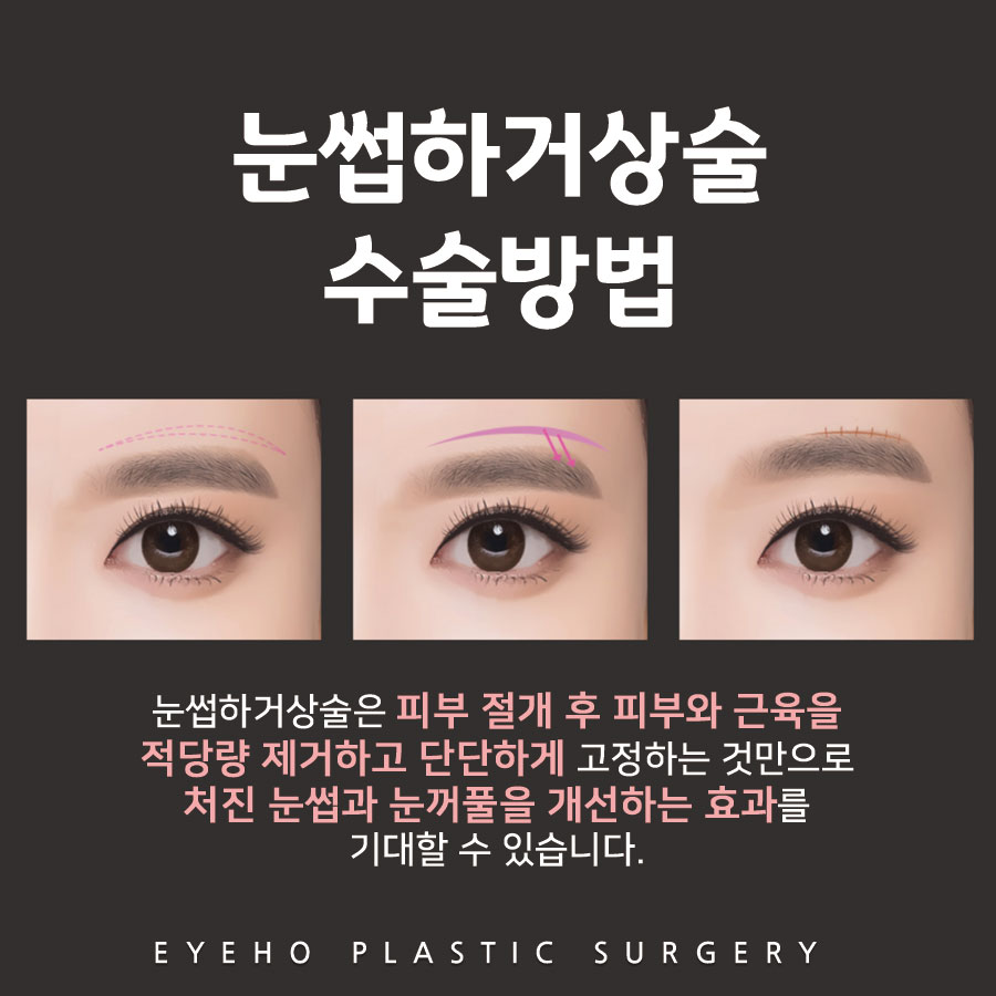 Brow Lift Cost and Brow Lift Review, Pain, and Precautions image 3