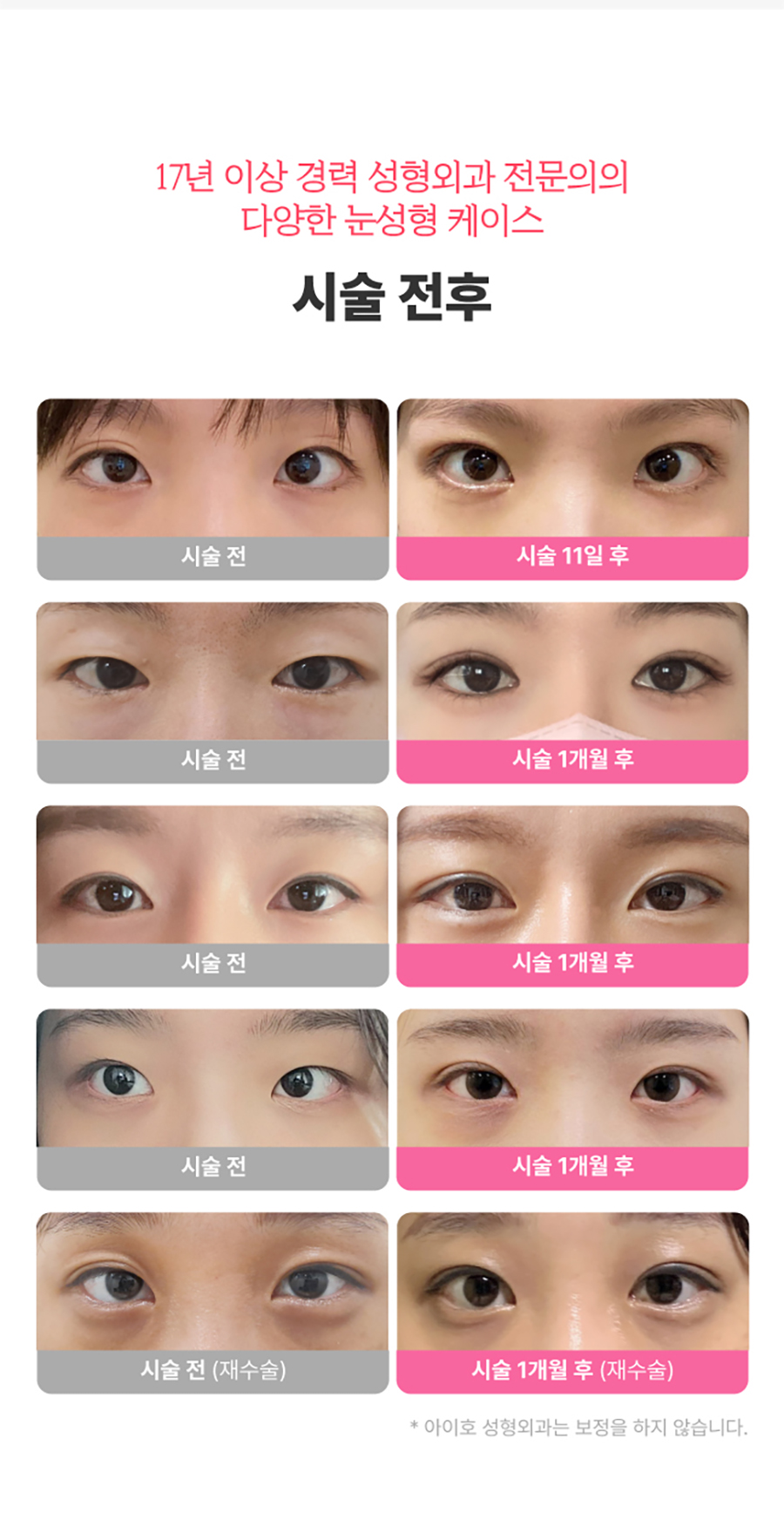 쌍수매몰법 매력적인 나만의 라인으로 관련 이미지 3