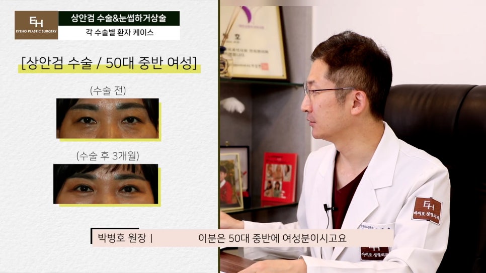 처진눈 상안검? 눈썹하거상술? 궁금하시다면 들어와!! 관련 이미지 32