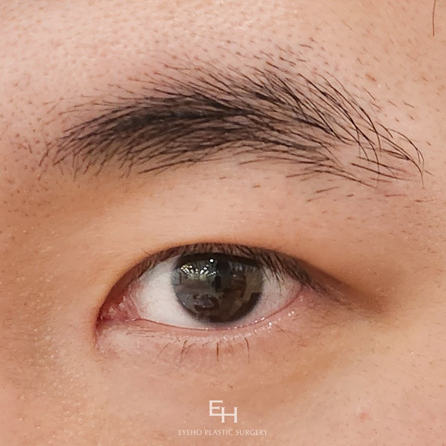 남자무쌍눈매교정비용 졸려 보이는 눈매 관련 이미지 15