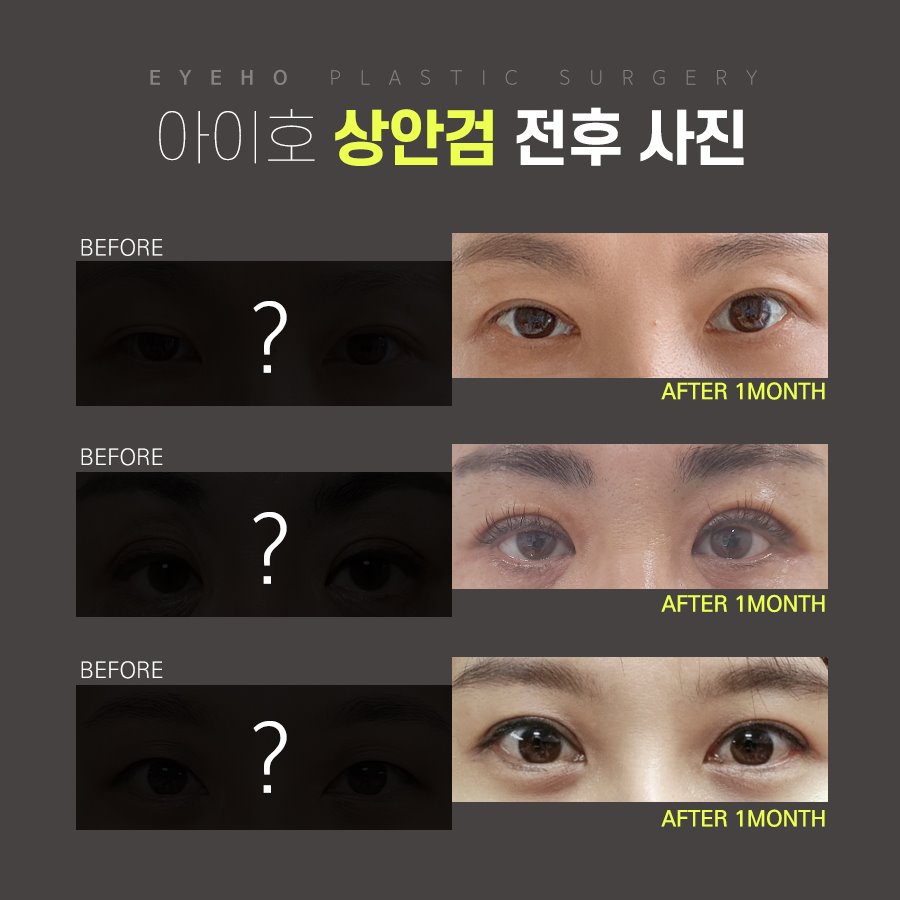 상안검수술가격 부작용 없이 회복기간 위하여 관련 이미지 4