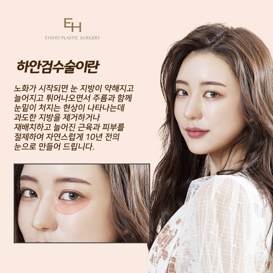 하안검 수술 후기 : 눈 밑 하안검 흉터 & 통증 / 잘하는곳 비교 분석 관련 이미지 2