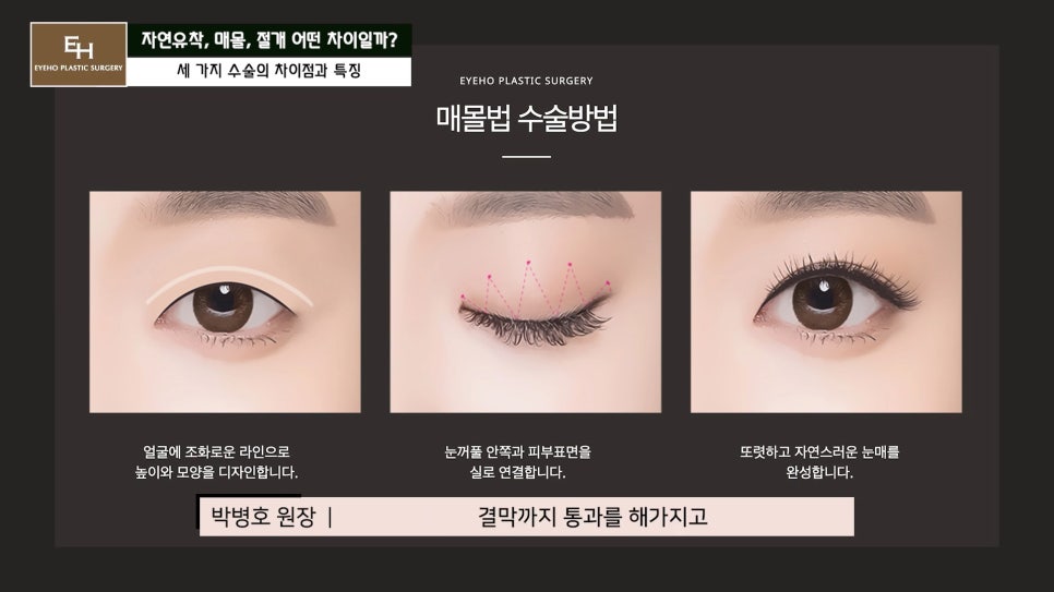 쌍수 자연유착 매몰 절개 차이점과 선택 기준 알려드릴게요. 관련 이미지 5