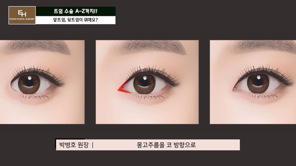 Everything About Canthoplasty, Explained by IHO image 10
