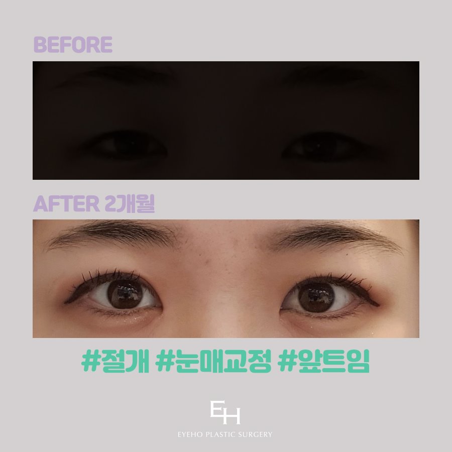 Before and After Ptosis Correction Surgery: Comparative Analysis of Methods and Costs for Correcting Asymmetrical Uneven Eyes image 19