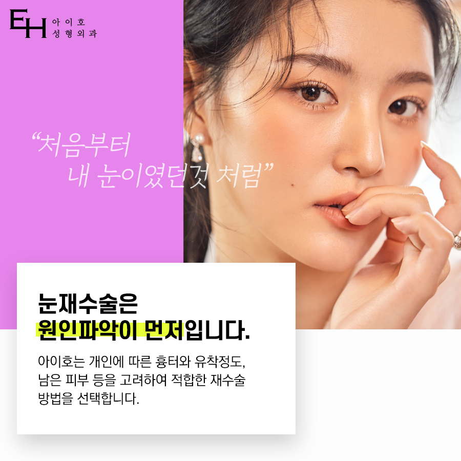 쌍꺼풀재수술비용 실패 원인 파악해보고 관련 이미지 2