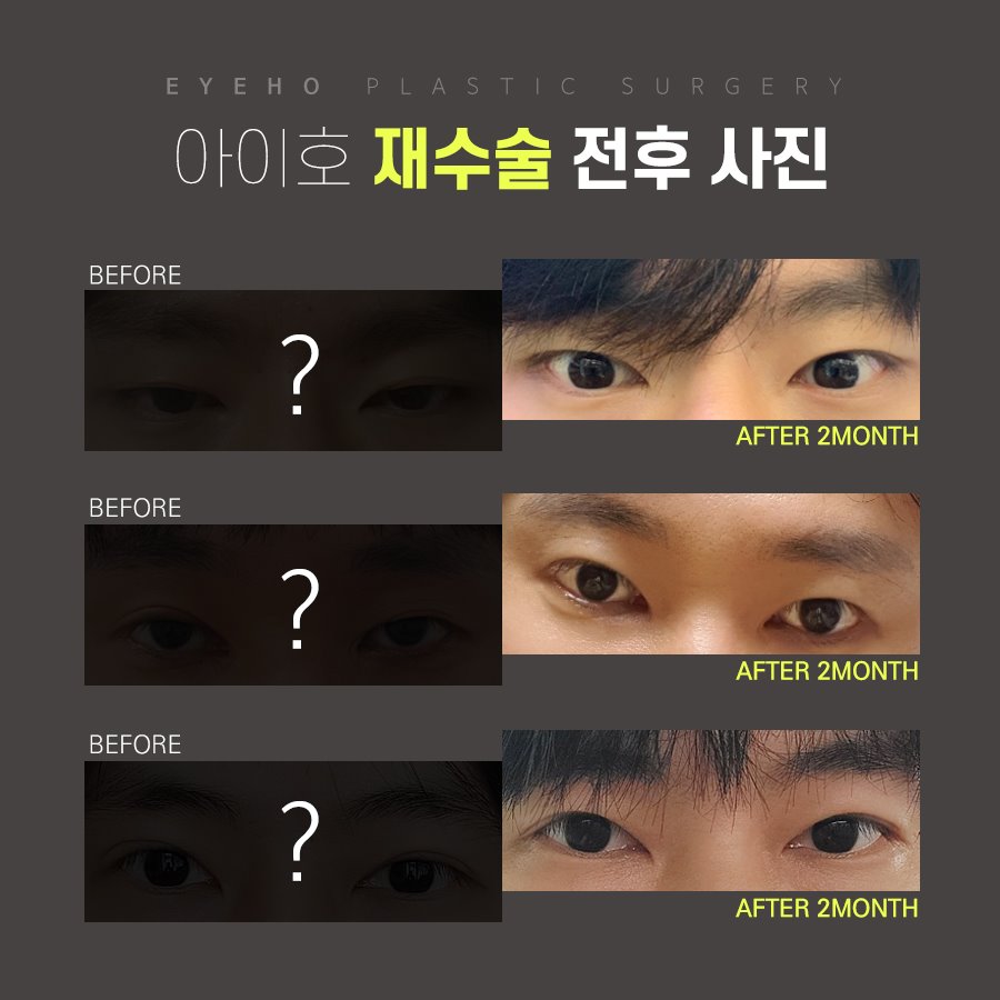 눈재수술비용 어떨때 개선해야 하나요? 관련 이미지 5