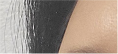 Brow Lift Cost and Brow Lift Review, Pain, and Precautions image 19