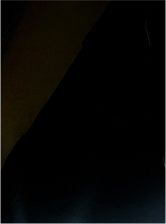 눈매교정 안검하수수술 비용 그리고 무쌍눈매교정후기 N일차 관련 이미지 18