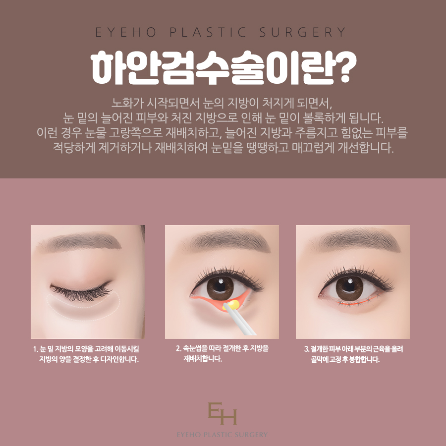Considering Eye Shape Elasticity in Drooping Eye Surgery image 4