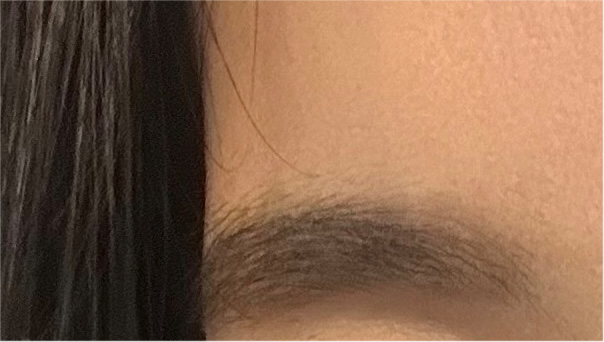 눈성형전후 디테일까지 꼼꼼하게 비교 관련 이미지 16