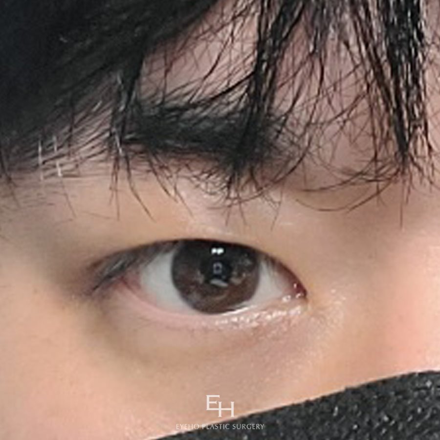 남자눈수술 느끼하지 않는 담백한 라인을 관련 이미지 14