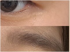 쌍꺼풀 수술 가격 및 후기 비교 분석 관련 이미지 22