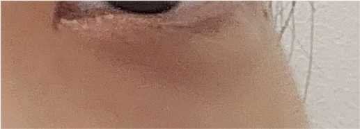 쌍수매몰법 매력적인 나만의 라인으로 관련 이미지 26