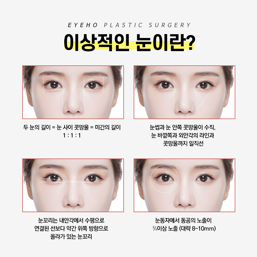쌍꺼풀수술 가격 & 비절개 눈매교정 후기 (7일 경과) / 짝눈쌍수 관련 이미지 5