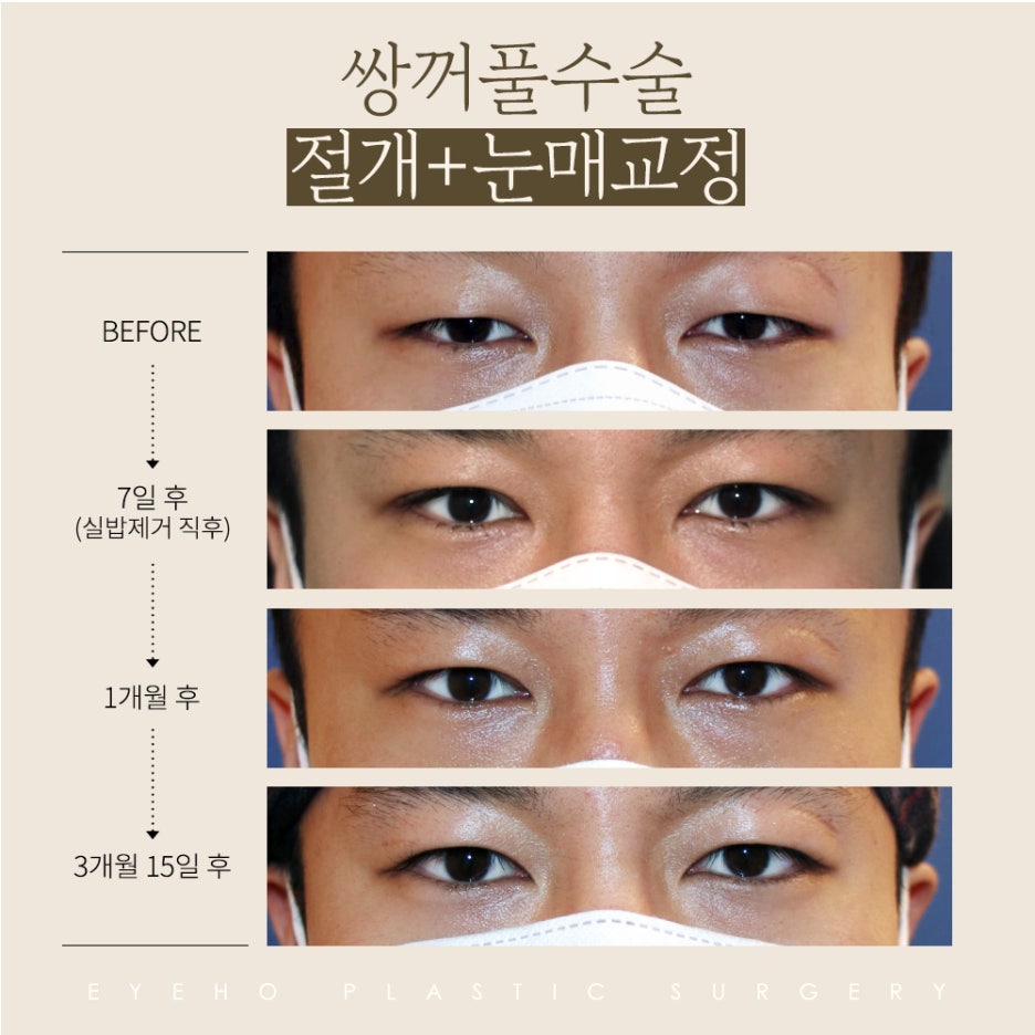 Before and After Male Eye Correction: Incisional Eyelid Correction Cost_ Monolid Ptosis Surgery Review (Day 1 to Day 7 Progress) image 4