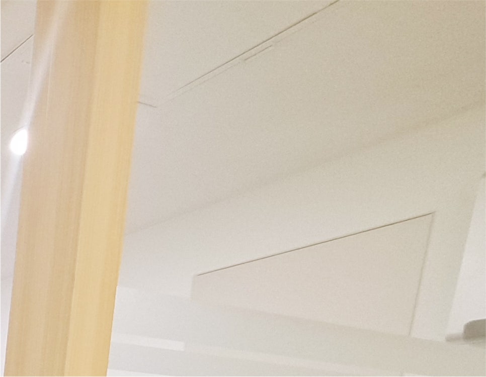 눈매교정 쌍수 : 무쌍 눈매교정 후기, 눈매교정 가격 비교 및 부작용 관련 이미지 18