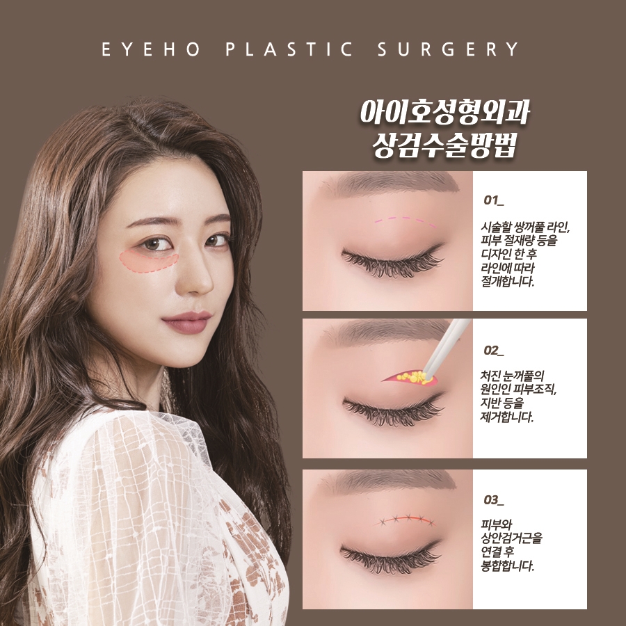 노화로 인한 상안검, 하안검 잘하는곳 찾는다면 관련 이미지 2