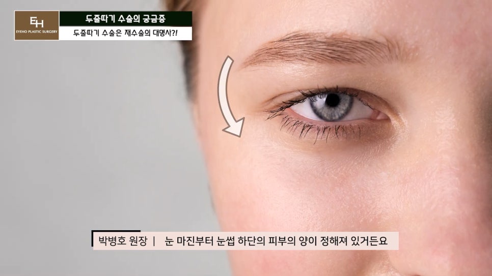 더 이상 물러설 때가 없는 재수술 두줄따기 궁금해요! 관련 이미지 21