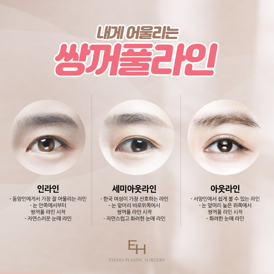Double Eyelid Surgery Review After 7 Days: Double Eyelid Surgery Cost and Price Comparison Analysis image 2
