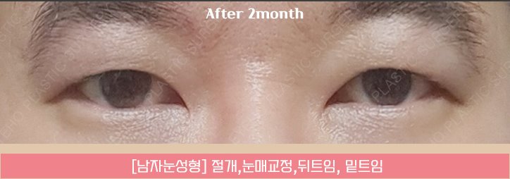 Men’s Eye Surgery: If You Want a Natural Look image 13