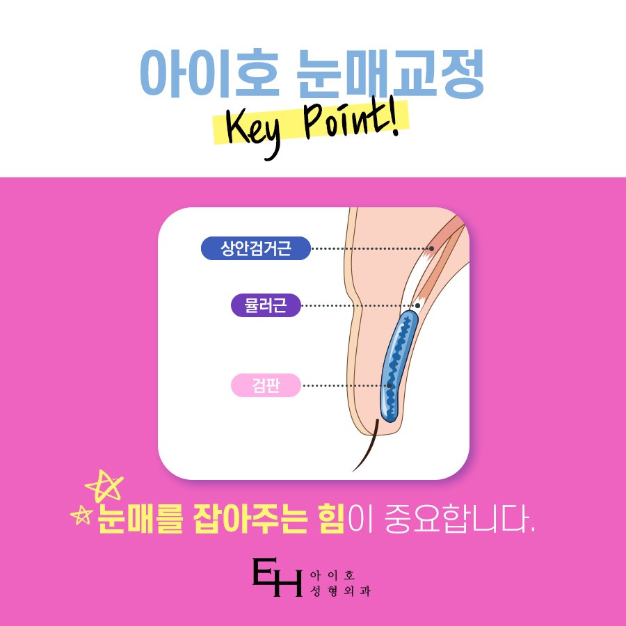 눈매교정술 또렷한 눈매나 관련 이미지 4